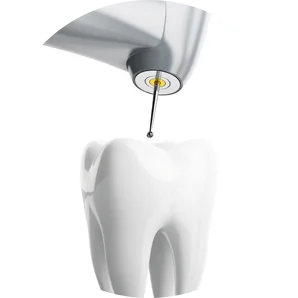 root canal