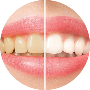 whitening